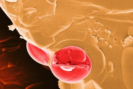 Image: Colored scanning electron micrograph (SEM) of a freeze fractured malarial red blood cell (erythrocyte, brown) infected with a Plasmodium falciparum protozoan (red) (photo courtesy of the NIBSC).